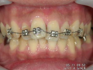 部分矯正は前歯のみの矯正治療