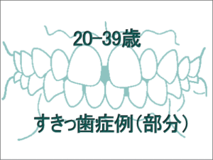 前歯のすきっ歯矯正治療例（20歳～39歳）