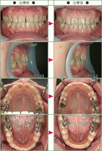 前歯のすきっ歯矯正症例(Ａｎｎ様　３５歳　女性)