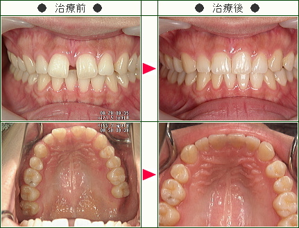 前歯のすきっ歯矯正症例(ちか様　２５歳　女性)