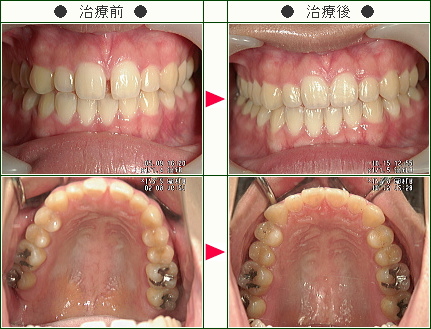前歯のすきっ歯矯正症例(Ｃ・Ｍ様　１９歳　女性)