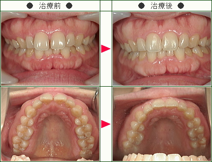 前歯のすきっ歯矯正症例(Ｅ様　３９歳　女性)