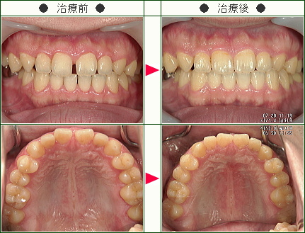 前歯のすきっ歯矯正症例(Ｋ.Ｋ様　３５歳　男性)
