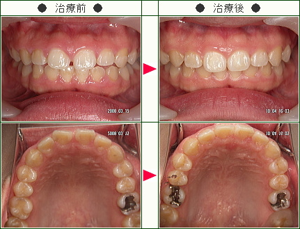 前歯のすきっ歯矯正症例(久美様　２７歳　女性)