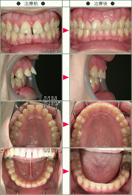 前歯のすきっ歯矯正症例(Ｓ・Ｋ様　２５歳　男性)