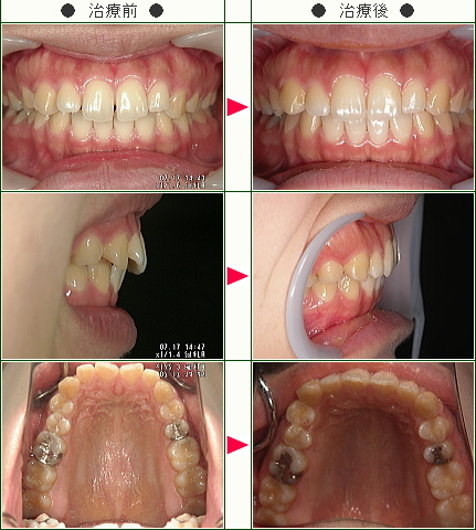 前歯のすきっ歯矯正症例(竹内様　２６歳　女性)