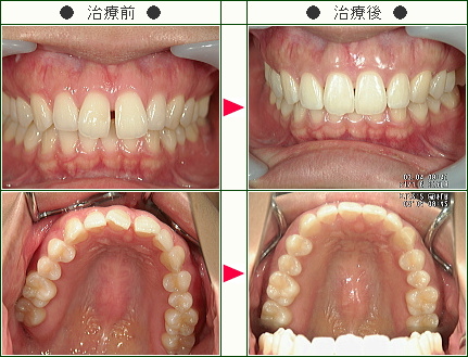 前歯のすきっ歯矯正症例(Ｕ.Ｓ様　２７歳　女性)
