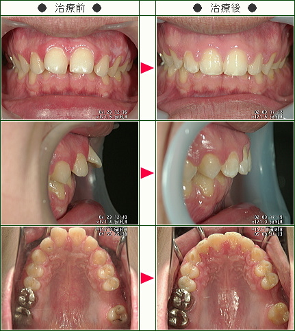 前歯のすきっ歯矯正症例(Ｙ.Ｈ様　２４歳　男性)
