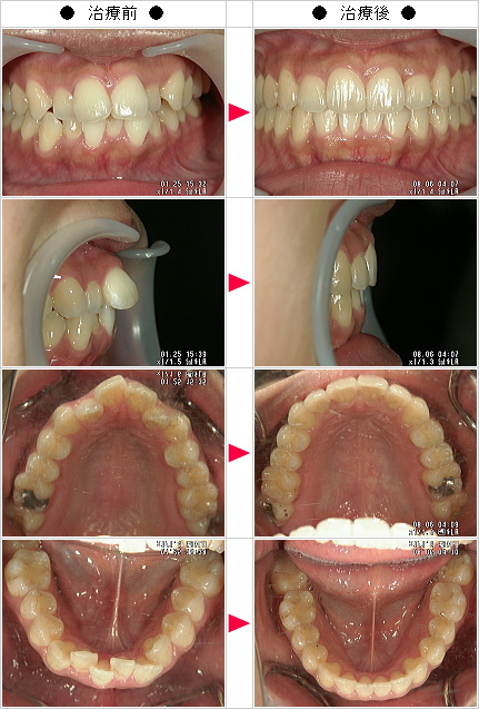 マウスピース矯正-歯のデコボコ矯正症例(Ｃ.Ａ様　２９歳　女性)