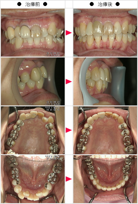 マウスピース矯正-歯のデコボコ矯正症例(Ｋ・Ｔ様　４１歳　女性)