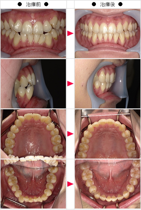 マウスピース矯正-歯のデコボコ矯正症例(Ｍ・Ｋ様　３３歳　女性)