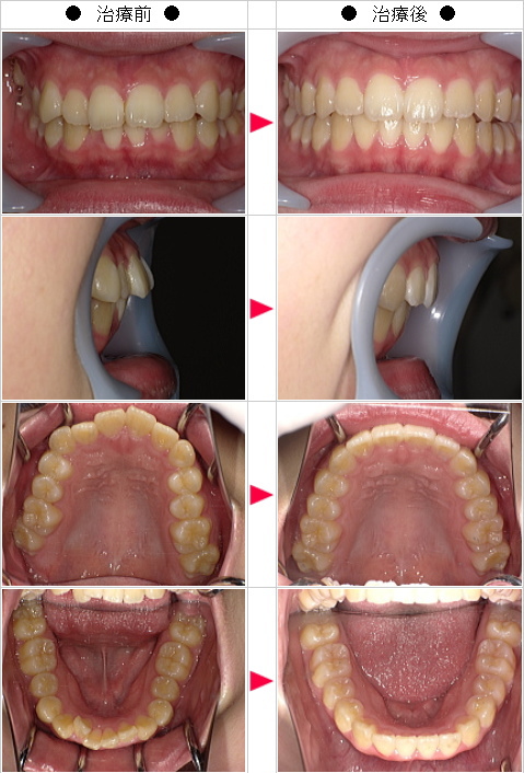 マウスピース矯正-歯のデコボコ矯正症例(Ｒ．Ｏ様　２１歳　女性)