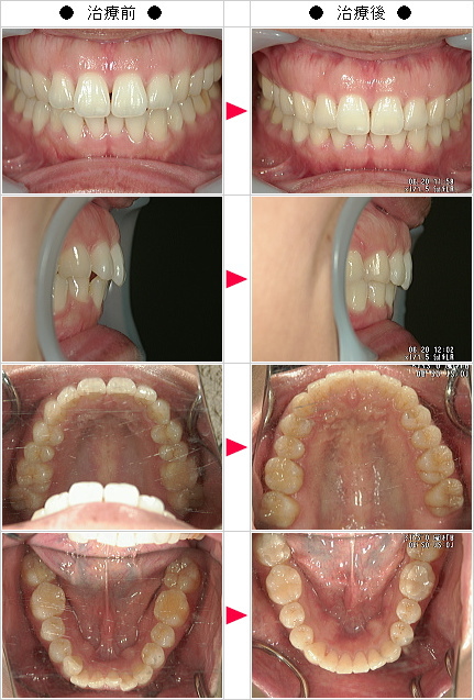 マウスピース矯正-歯のデコボコ矯正症例(玉井様　３４歳　女性)