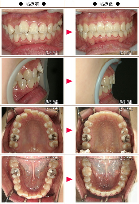 歯のデコボコ矯正症例(Ａ様　１７歳　女性)