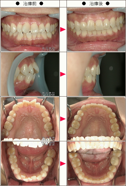 歯のデコボコ矯正症例(安立様　４０歳　女性)