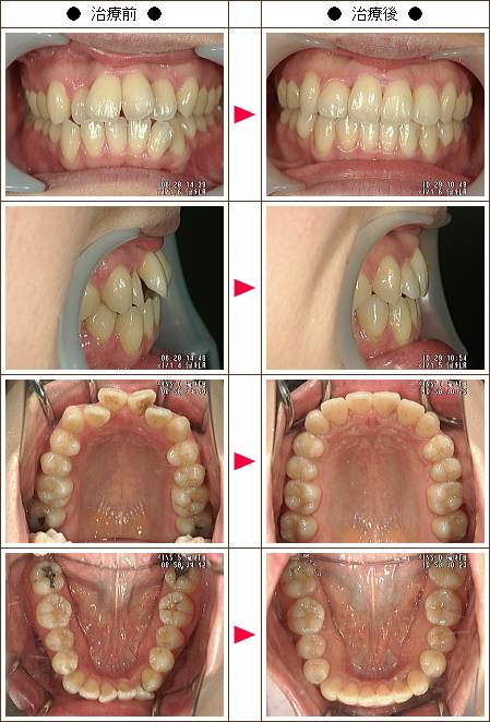 歯のデコボコ矯正症例(Ａ.Ｋ様　３２歳　女性)