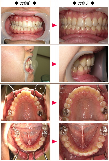 歯のデコボコ矯正症例(ａｙａ様　２９歳　女性)
