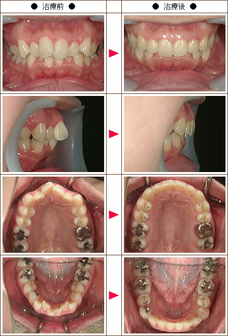 歯のデコボコ矯正症例(Ｉ様　１７歳　女性)