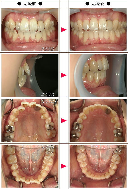 歯のデコボコ矯正症例(加藤様　２７歳　女性)