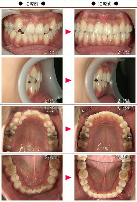 歯のデコボコ矯正症例(前田様　３４歳　女性)
