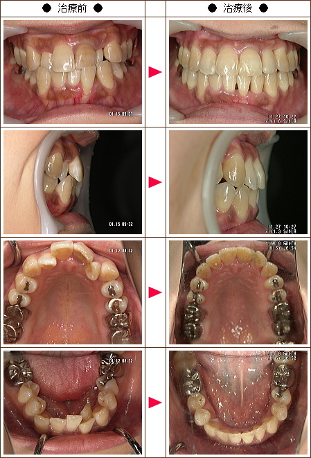 歯のデコボコ矯正症例(Ｍ・Ｉ様　４０歳　女性)
