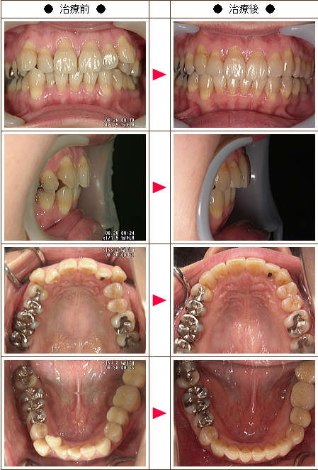 歯のデコボコ矯正症例(Ｎ・Ｈ様　４０歳　女性)