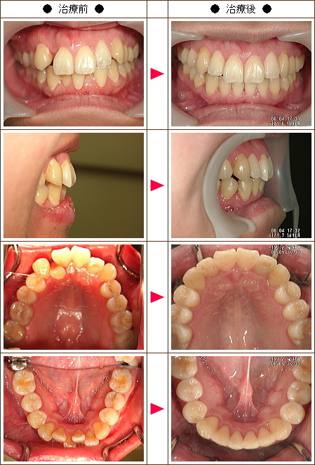 歯のデコボコ矯正症例(Ｓ様　２６歳　女性)