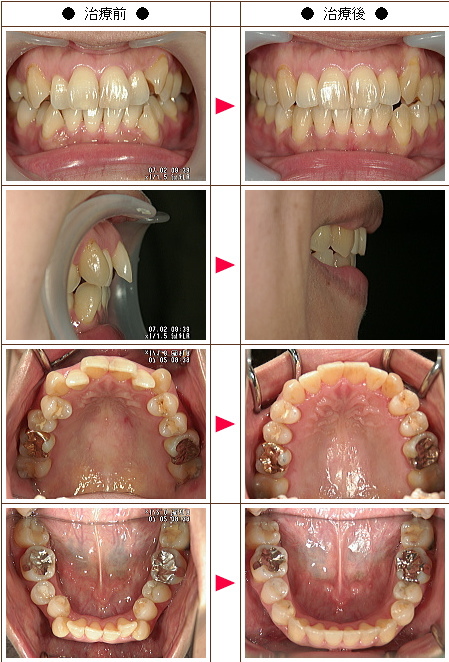 歯のデコボコ矯正症例(Ｔ・Ｉ様　４７歳　女性)