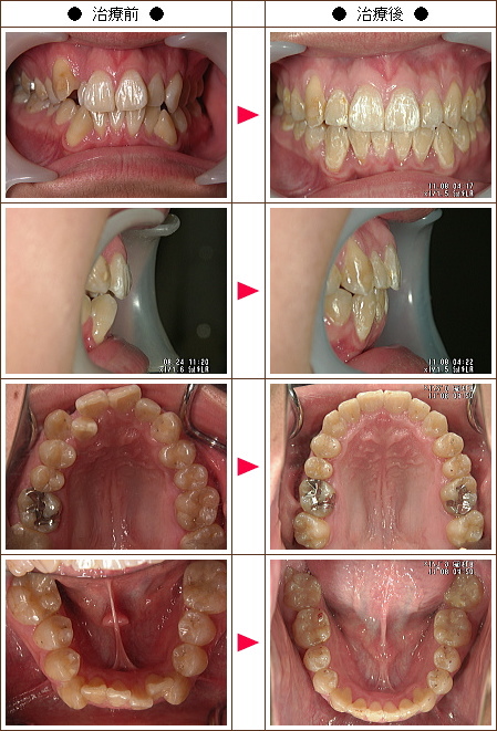 歯のデコボコ矯正症例(Ｔ．Ｍ様　１９歳　男性)