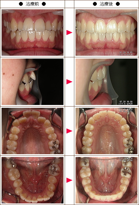 歯のデコボコ矯正症例(Ｙ様　２３歳　女性)