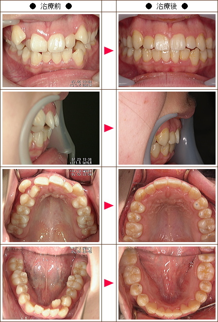 歯のデコボコ矯正症例(山口様　１５歳　女性)