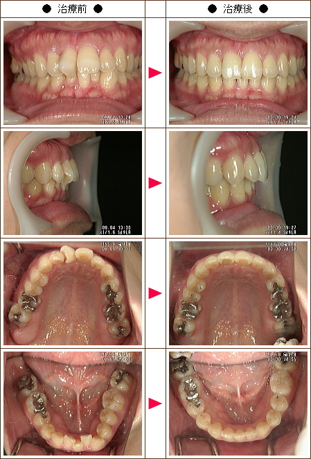 歯のデコボコ矯正症例(ＹＫＮ様　３２歳　女性)