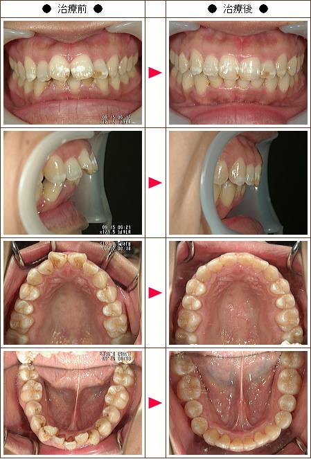歯のデコボコ矯正症例(Ｙ・Ｍ様　３６歳　女性)