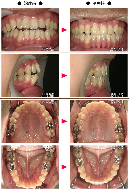 歯の開口矯正症例(Ｆ・Ｙ様　２５歳　男性)