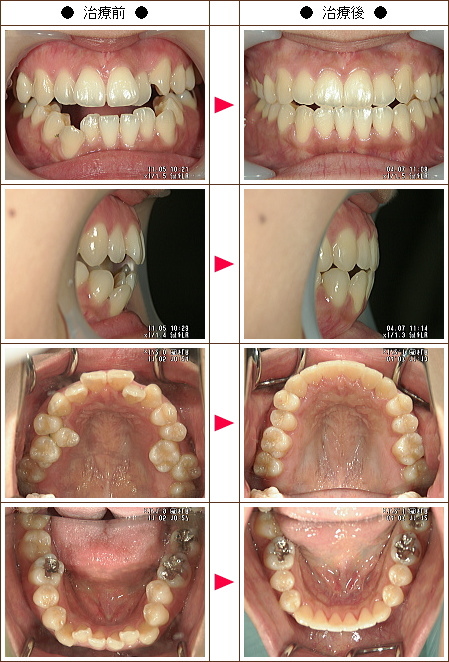 歯の開口矯正症例(福島様　３２歳　女性)