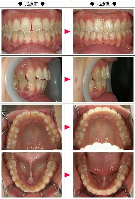 歯の開口矯正症例(Ｍ.Ｂ様　３１歳　女性)