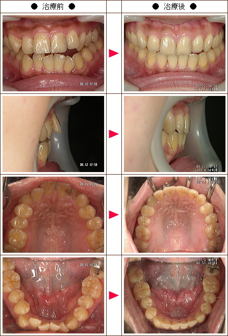 歯の開口矯正症例(めぐみ様　３１歳　女性)