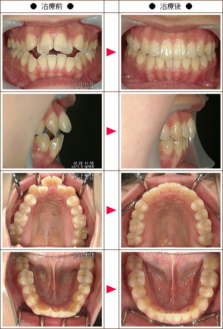 歯の開口矯正症例(Ｍ.Ｍ様　２５歳　女性)
