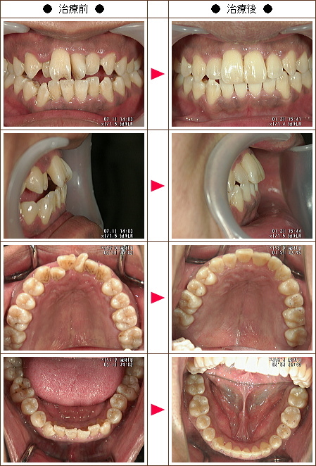 歯の開口矯正症例(Ｓ・Ｒ様　３２歳　男性)