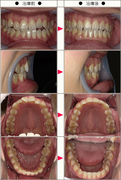 歯の開口矯正症例(Ｔ.Ｎ様　女性)