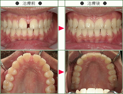 前歯のすきっ歯矯正症例(Ｋ.Ｓ様　１８歳　女性)