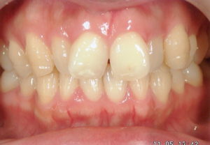 前歯のデコボコを簡単に治す！症例の徹底解説！！