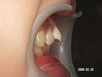 前歯の出っ歯を簡単に治す！！症例の徹底解説