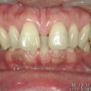 前歯のすきっ歯を簡単に治す