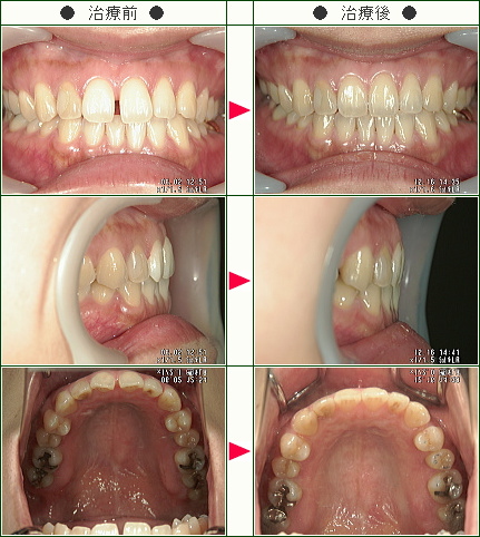 前歯のすきっ歯矯正症例(Ｒ・Ｉ様　３５歳　女性)