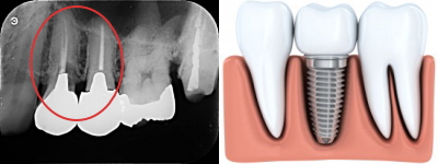 パントモでの失活歯とインプラントの写真と説明